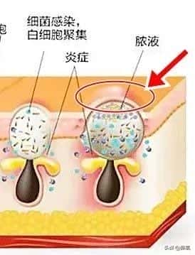 娥罗纳英软膏有什么作用（娥罗纳英h软膏）