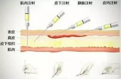 ​经验干货分享：注射技巧总结大全！仅此一份！